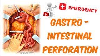 Gastrointestinal Perforation