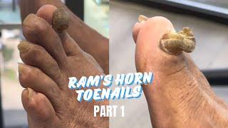 2 RAM’S HORN TOENAILS?! + PEDICURE [PART 1]
