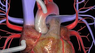 Koronararterien-Bypass (CABG)