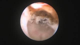 Laser urethrotomy. Dr Farid Gadimaliyev, Baku, Azerbaijan