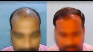 My Hair Transplant (2019) Results | 3554 Grafts | Stage 7 Baldness