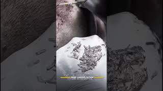 Implantación de folículos en un implante capilar | Care4Hair