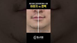 제모 장비 비교!! #레이저제모 #젠맥 #아포지