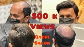 Vig Unit Hair Patch Treatment Tutorial, Step-By-Step 2024￼ Tanveer Naz Qadri “03034024816