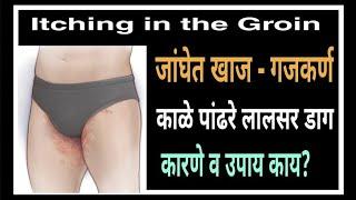 Itching in the Groin|जांघेत खाज-गजकर्ण.काळे पांढरे लालसर डाग.कारणे व उपाय काय?|747|@drramjawale