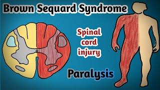 paralysis on one side (hemiplegia) #brownsequardsyndrome #hemiplegia