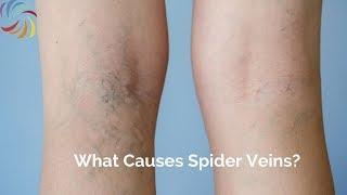 What causes spider veins?