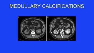 Endourologic Management of Medullary Sponge Kidney