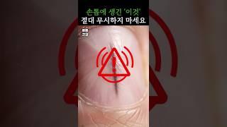 손톱에 생긴 검은색 줄, 절대 무시하지 마세요 #건강