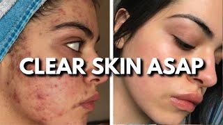 Clear Your Skin: The Ultimate Acne Routine for Breakouts, Dry Skin & More!