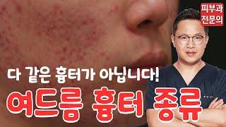 여드름 흉터 종류가 다를까? 다 같은 여드름흉터가 아닙니다!