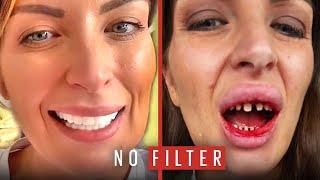 The Horrible Truth Behind My 'Turkey Teeth' | No Filter