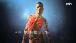 [HIT] 생로병사의 비밀 - 틀어지고 휘어진 허리 ‘척추측만증’.20150408