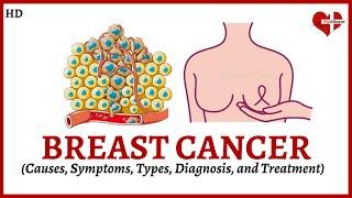 Overview of Breast Cancer:  Causes, Symptoms, Types, and Treatment Explained