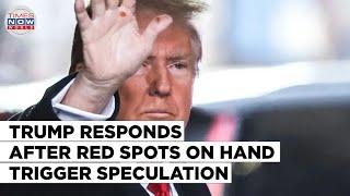 Donald Trump's Reaction to Speculation Over Red Spots on Hand | World News Update