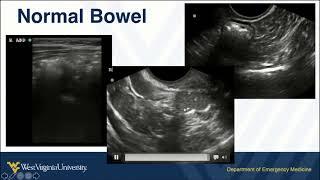 Normal Bowel on POCUS