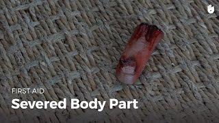 Learn first aid gestures: Severed Body Part