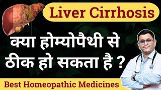 Liver cirrhosis homeopathy treatment Homeopathic medicine for Liver Cirrhosis