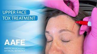 Upper Face Tox Treatment