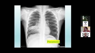 Pediatric Pneumonia Case | TeleShadowing