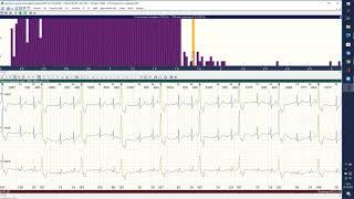 Практичний онлайн майстер-клас ECGpro Holter 28/01/2022