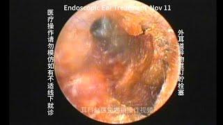 External auditory canal foreign body mixed with cerumen embolism 20241111