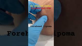 Forehead lipoma #skincare dr Khaled Sadek LIPOMACYST clinic