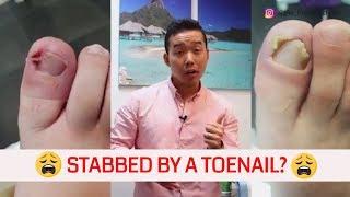 3 Best Ways to get RID of ingrown toenails | Foot Dr