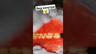 Протез БЕЗ НЁБА! #безнёбасъёмныепротезы #съёмныезубныепротезы #съёмныепротезы
