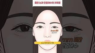 졸린 눈과 안검하수의 차이점 #shorts