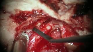 Perigeniculate Giant Cell Tumor of Temporal Bone: A Detailed Case Study