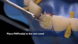 Dentapreg PINPost