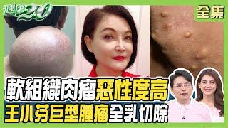 王小芬乳房 巨型腫瘤 全乳切除！ 軟組織肉瘤惡性度高 脂肪瘤 表皮囊腫 怎麼分？健康2.0 20230826【完整版】江坤俊 韋汝 蔡欣恬 陳欣湄 吳明珠 洪素卿 雷議宗@tvbshealth20