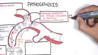 Malaria Pathophysiology