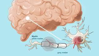 Multiple Sclerosis Fast Facts - Karger