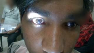 RELATIVE AFFERENT PUPILLARY DEFECT