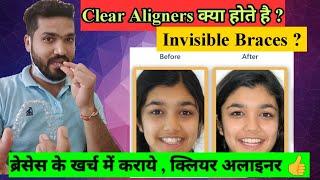 What is Clear Aligner ? Time & Cost | Aligners क्या होते है ? समय और इनका खर्च !