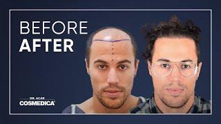 The fascinating change in our patient after his hair transplant surgery.