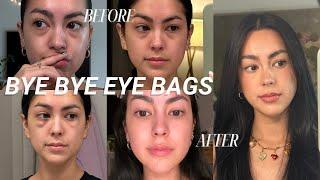 How I finally got rid of my eye bags || lower blepharoplasty vlog