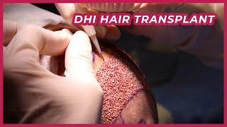 Dhi Hair Transplant All Proces / Which technique is right for you?