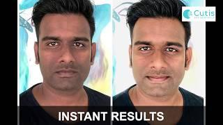 Instant Result of Adam Facial | Mens Skin Care | Cutis Skin Solution