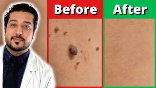 How to Rid Skin Tags FASTER | 3 Easy Skin Tag Removal Steps