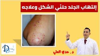 الفقاع الحلئي dermatitis herpetiformis