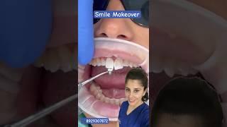 Smile Makeover with minimal cost | Veneers |Composite-Dr Pratibha #shorts #dental #viral #veneers