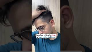 Watch to identify Male Pattern Baldness #manmatters #malepatternbaldness #hairfallsolution #hairfall