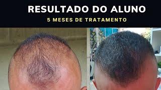 Transformação em 5 Meses: Veja os Resultados Contra a Calvície Masculina