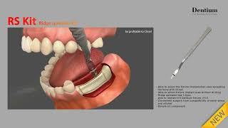 Dentium NR Line Implant Ridge Spreader Kit