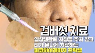 검버섯 치료 피코프락셀레이저 일상생활에 지장을 주지 않고 치료합니다.산본오라클피부과