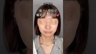 爆美女鼻になれる？#astrabeautyclinic  #アストラビューティークリニック #塩満恵子 #鼻整形 #美容整形 #忘れ鼻