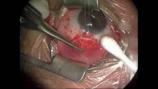 Pars planectomy: a new glaucoma filtering technique - Supplementary video [ID 299347]